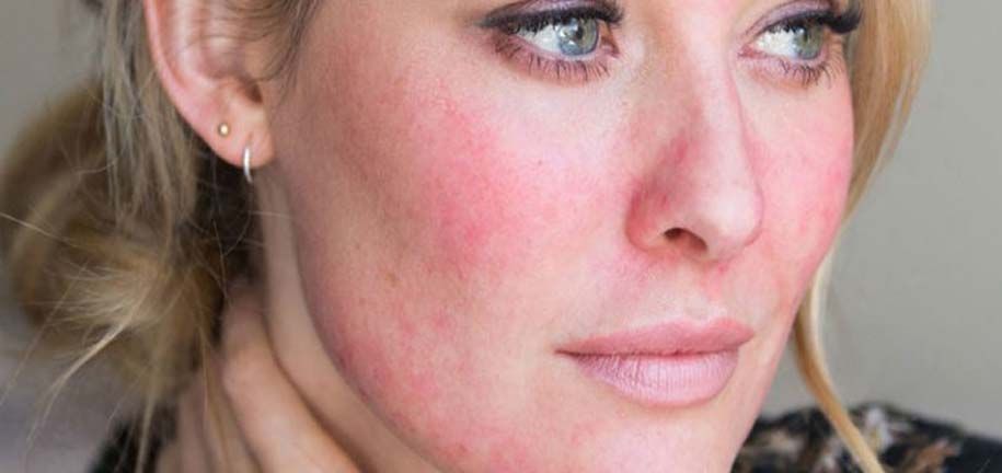 Сухая и раздражённая кожа