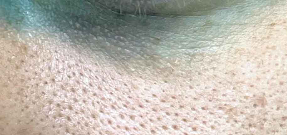 расширенные поры на лице