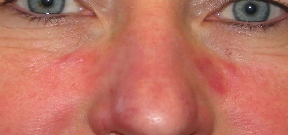 Seborrheic Skin Routine