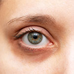 Темные круги под глазами