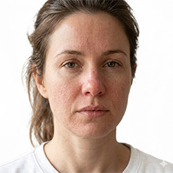 Уход за сухой и раздраженной кожей