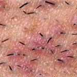 ingrown hair solutions