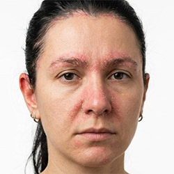 Уход за кожей при себорее для лица и кожи головы